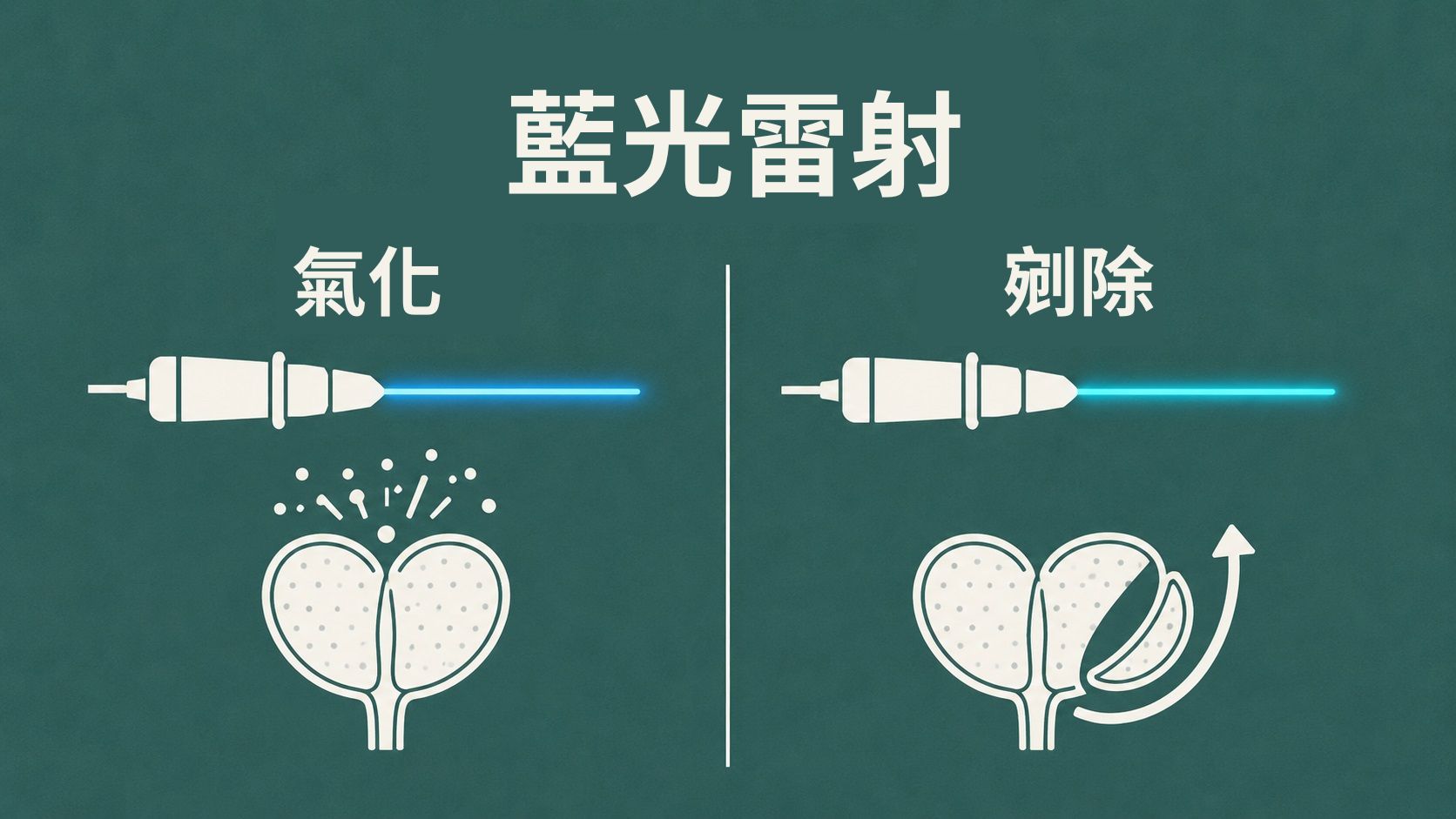 攝護腺肥大治療：告別排尿困擾，重拾順暢人生｜長安醫院泌尿科
